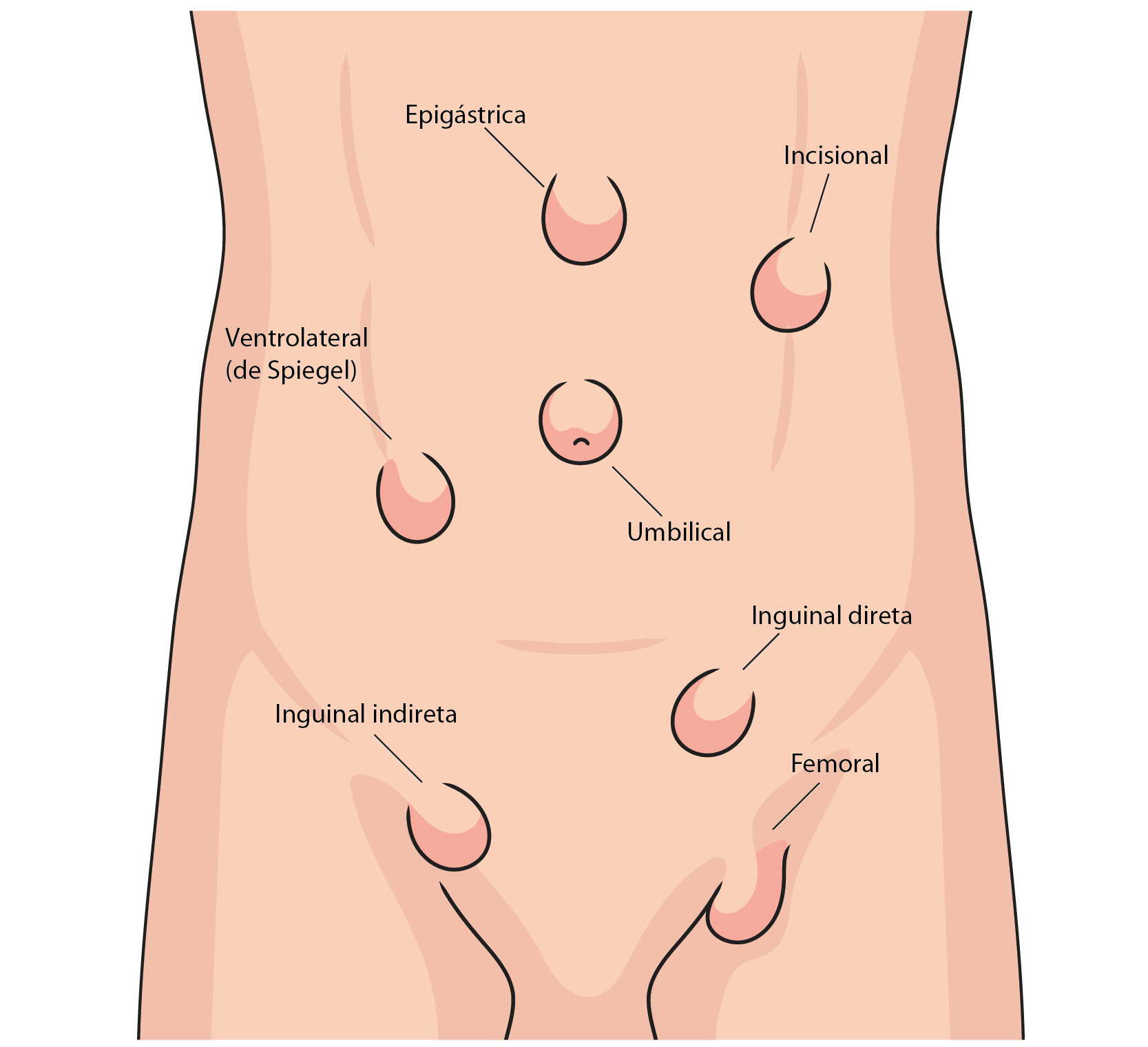 1. Hérnias da Parede Abdominal - Dr. Ian Hernandez - Cirurgião Geral